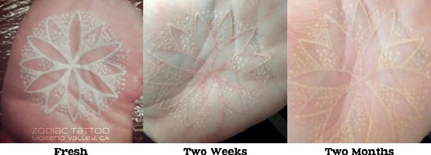 Eliminar tatuajes blancos con láser