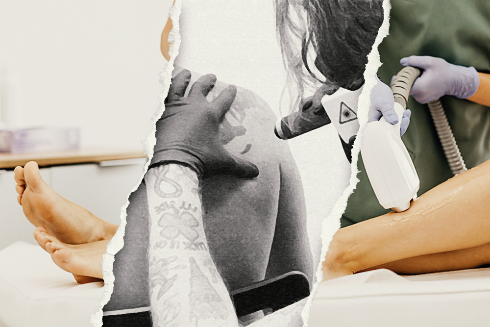 ¿Sirve el mismo láser para eliminar tatuajes y para depilar?